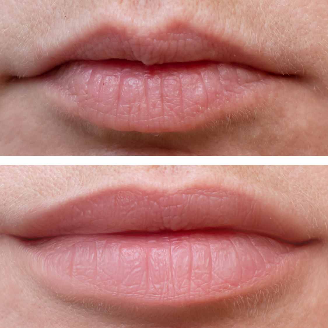 Before & After Lip Filler
