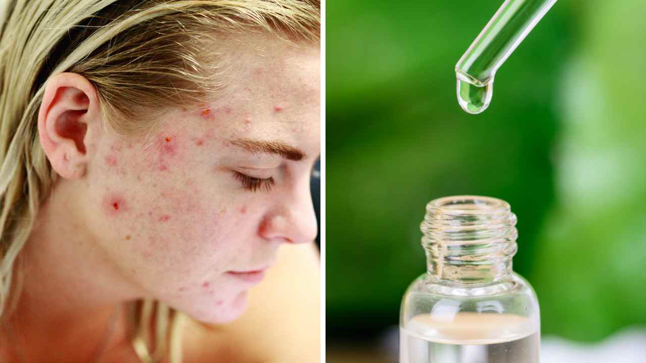 Does Niacinamide Help with Acne? The Science Behind It!