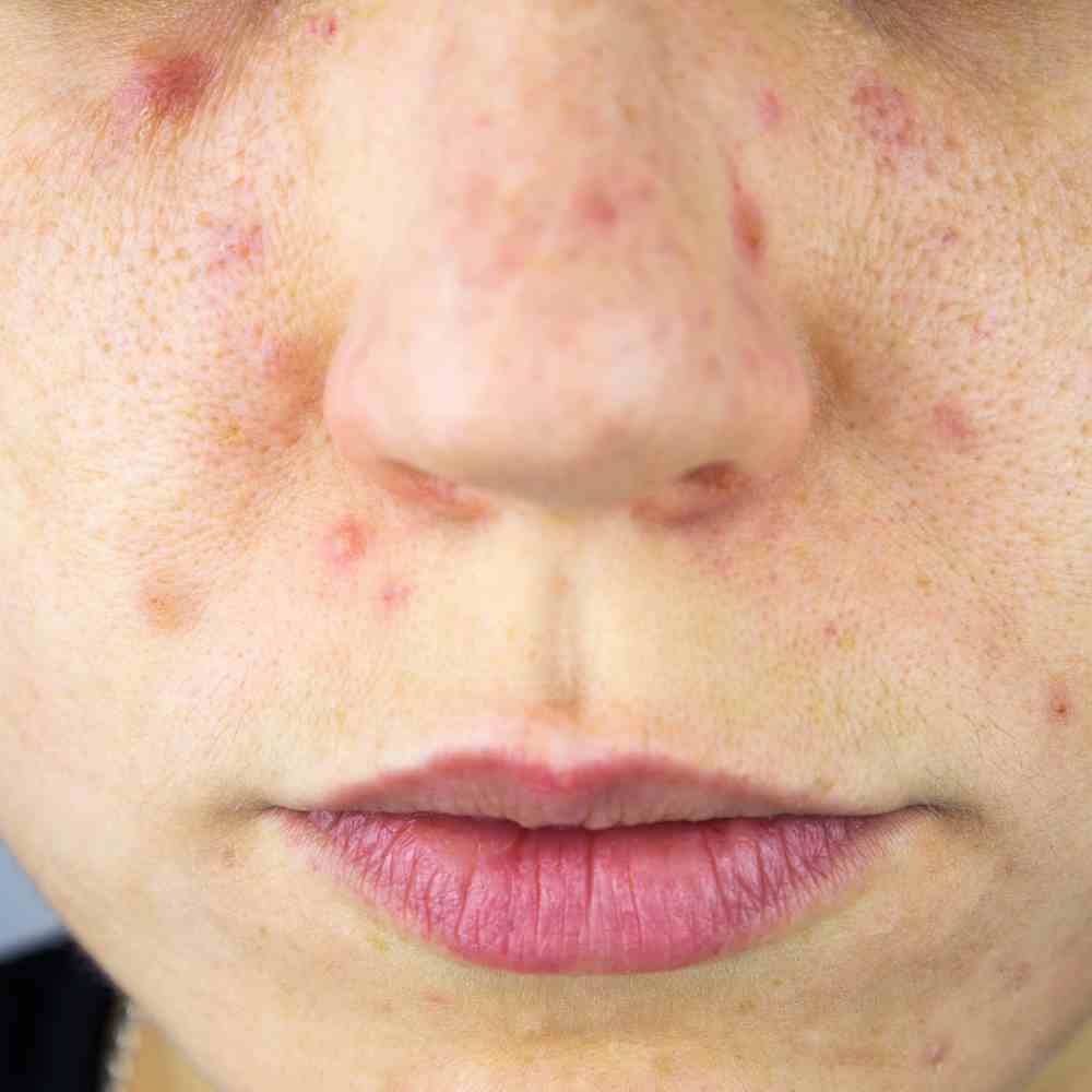 Does Cerave Moisturizing Cream Cause Acne? The Truth!