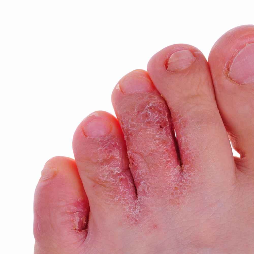 Athlete's Foot vs Dry Skin: How to Tell the Difference