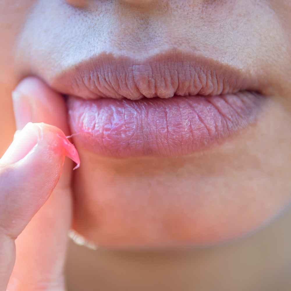 Dry Patch on Lip Dilemma: How to Treat Dry Lip Patches Quickly!