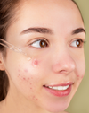 best acne spot treatment