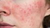 what is rosacea