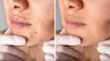 Does Tretinoin Help with Acne Scars