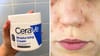 Does Cerave Moisturizing Cream Cause Acne