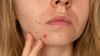 Is Acne a Sign of Pregnancy