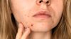 How to Tell if Acne is Hormonal or Bacterial