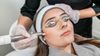 laser treatment for acne