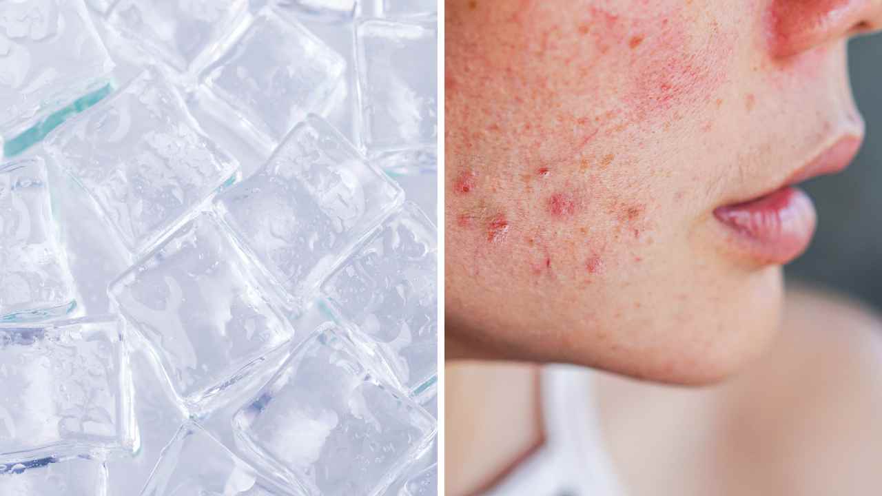 Brrring on the Benefits Does Ice Help Acne Breakouts?