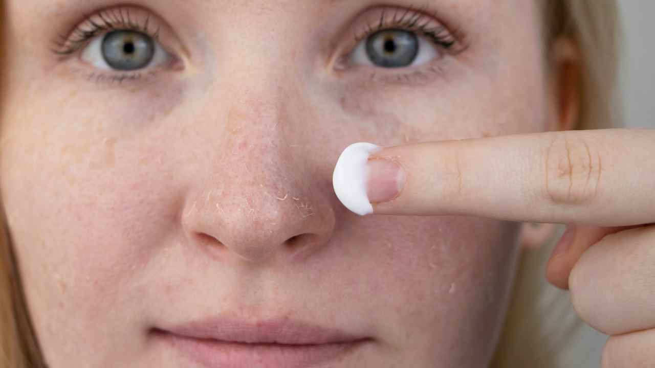 Dry Skin & Acne Dilemma Can Dry Skin Cause Breakouts?