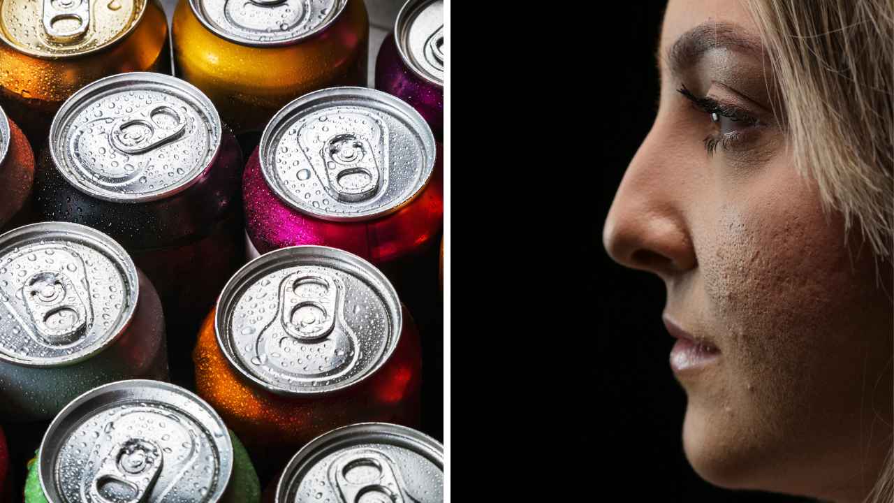 From Can to Can't? Does Soda Cause Acne Breakouts?