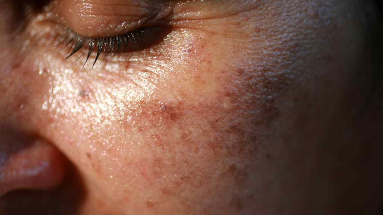 Sunlight vs. Pimples Is Sun Good or Bad for Acne?