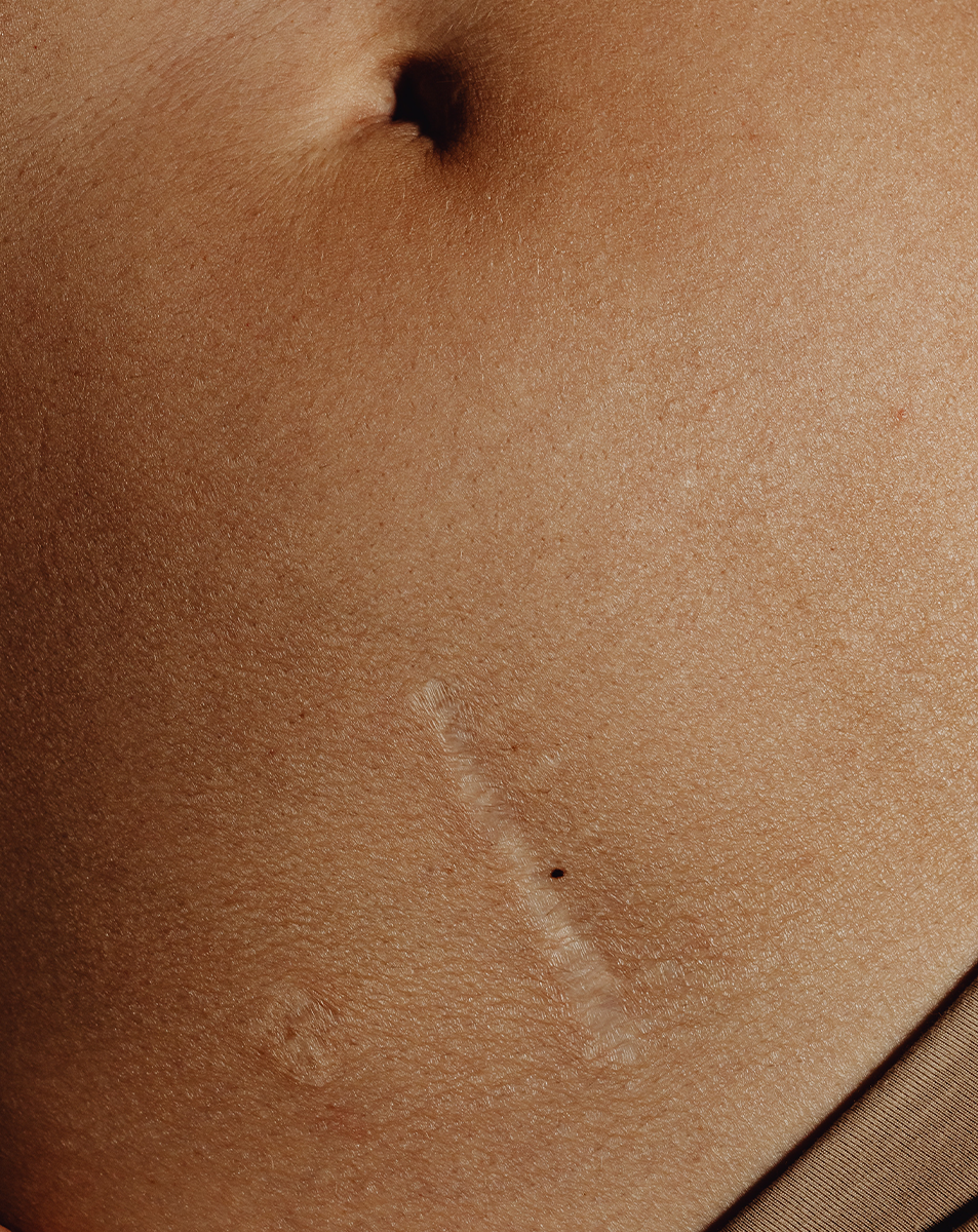 best silicone scar sheets