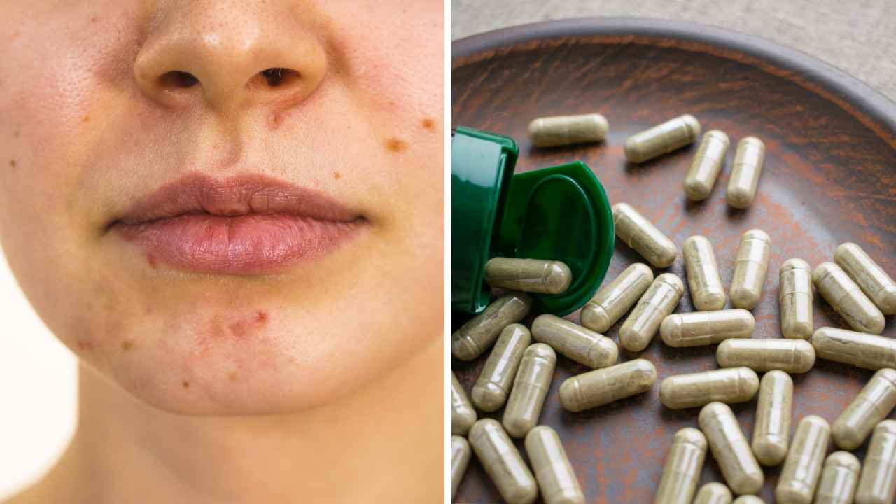 Does Biotin Cause Acne