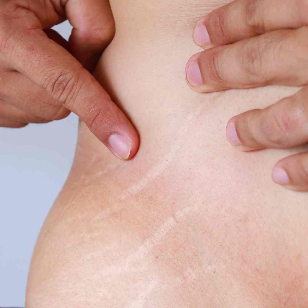 Will Stretch Marks Go Away After Losing Weight Do Stretch Marks Go Away When You Lose Weight? The Facts!