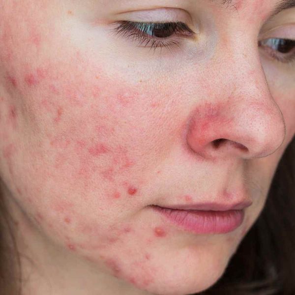 Power of Hydration Is Hyaluronic Acid Good for Rosacea?