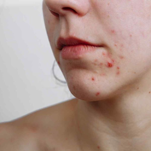 Scar Free Skin Does Accutane Get Rid of Acne Scars?