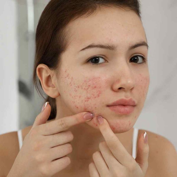 Peanut Butter & Pimples Does Peanut Butter Cause Acne?