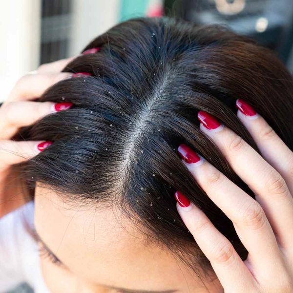 Who Knew! Glycolic Acid for Dandruff? Here's Exactly How!