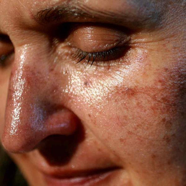 Sunlight vs. Pimples Is Sun Good or Bad for Acne?